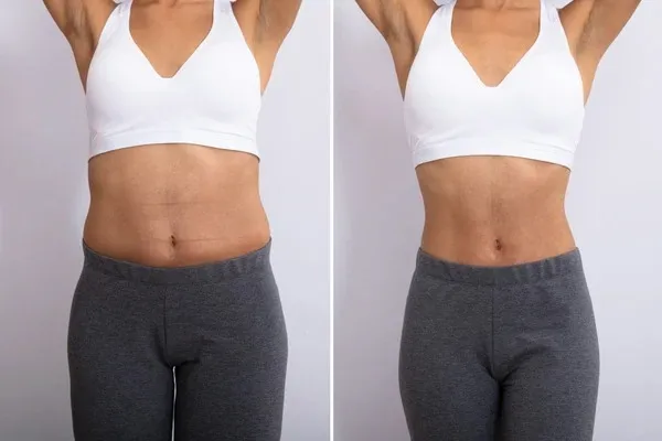 What Is Evolve Body Contouring?